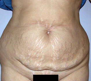Images abdominoplasties