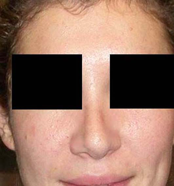 chirurgie-esthetique-interventions-nez-rhinoplasties-005
