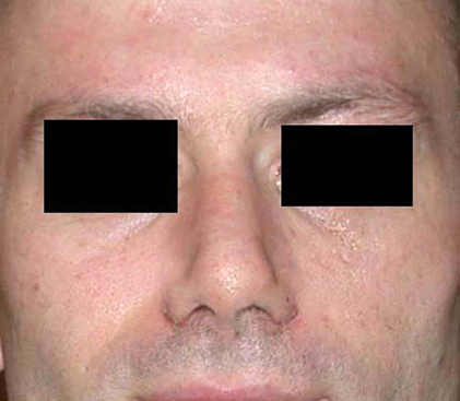 chirurgie-esthetique-interventions-nez-rhinoplasties-054