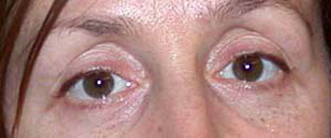 chirurgie-esthetique-interventions-paupieres-001