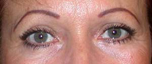 chirurgie-esthetique-interventions-paupieres-015