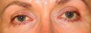 chirurgie-esthetique-interventions-paupieres-025