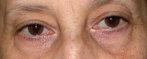 chirurgie-esthetique-interventions-paupieres-030