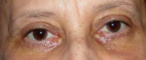 chirurgie-esthetique-interventions-paupieres-031