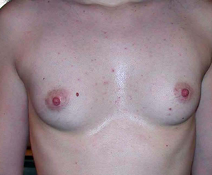 chirurgie-esthetique-interventions-seins-augmentations-mammaires-000