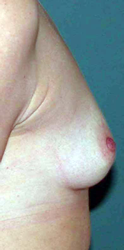 chirurgie-esthetique-interventions-seins-augmentations-mammaires-035