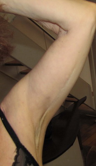 Images chirurgie des bras