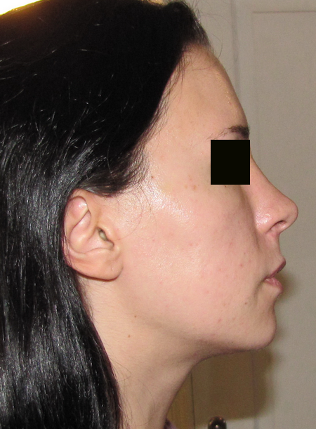 implants-malaires6