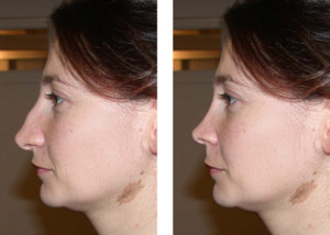 Images rhinoplasties