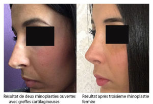 rhinoplastie-fermee-la-seule-esthétique-1-300x203