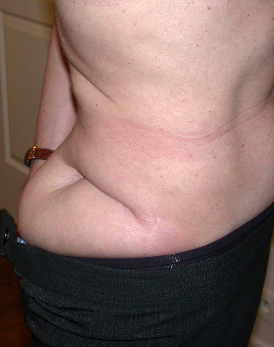 Images cicatrices, kystes, grains de beauté, tatouages