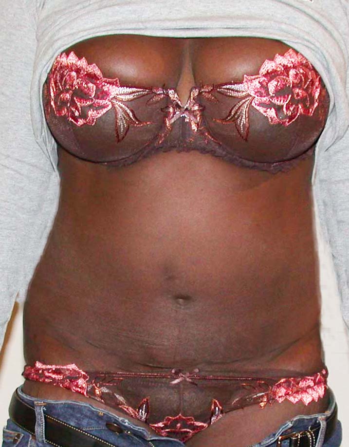 chirurgie-esthetique-pierre-nahon-abdomens01
