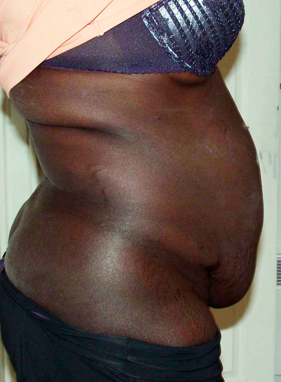 chirurgie-esthetique-pierre-nahon-abdomens02