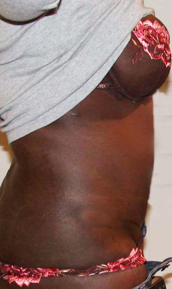 chirurgie-esthetique-pierre-nahon-abdomens03