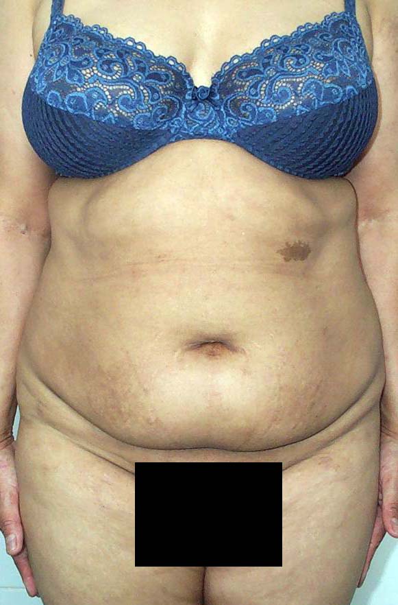 chirurgie-esthetique-pierre-nahon-abdomens04