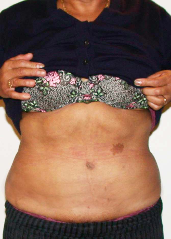 chirurgie-esthetique-pierre-nahon-abdomens05