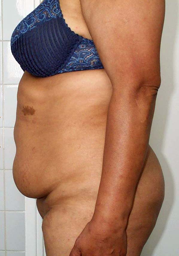 chirurgie-esthetique-pierre-nahon-abdomens06