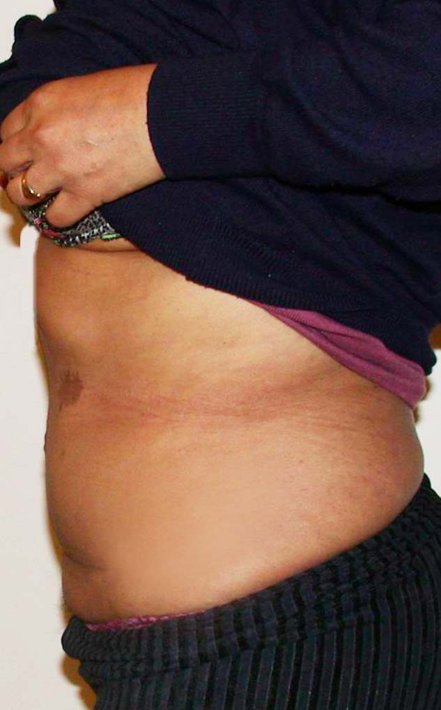 chirurgie-esthetique-pierre-nahon-abdomens07