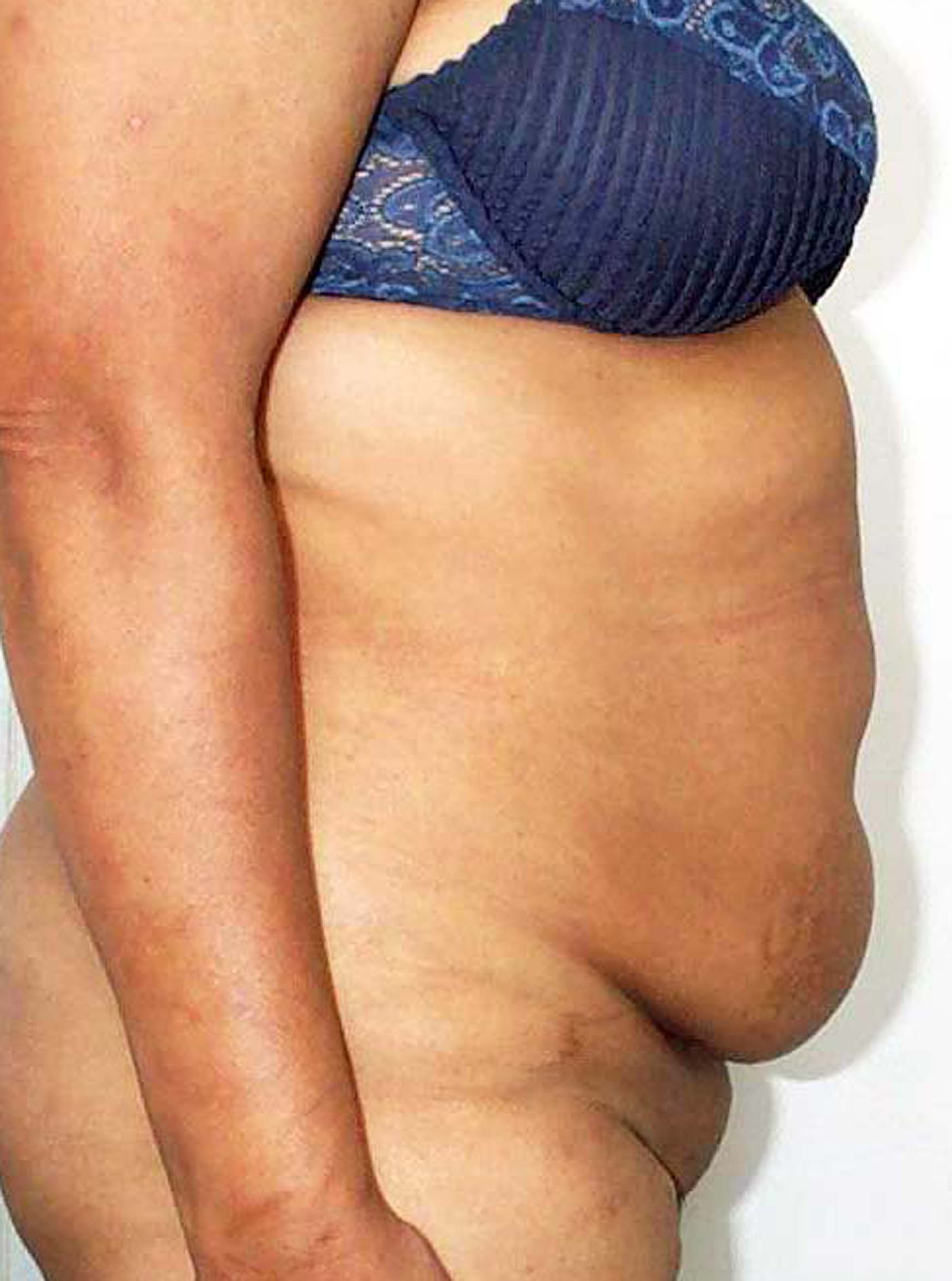 chirurgie-esthetique-pierre-nahon-abdomens08