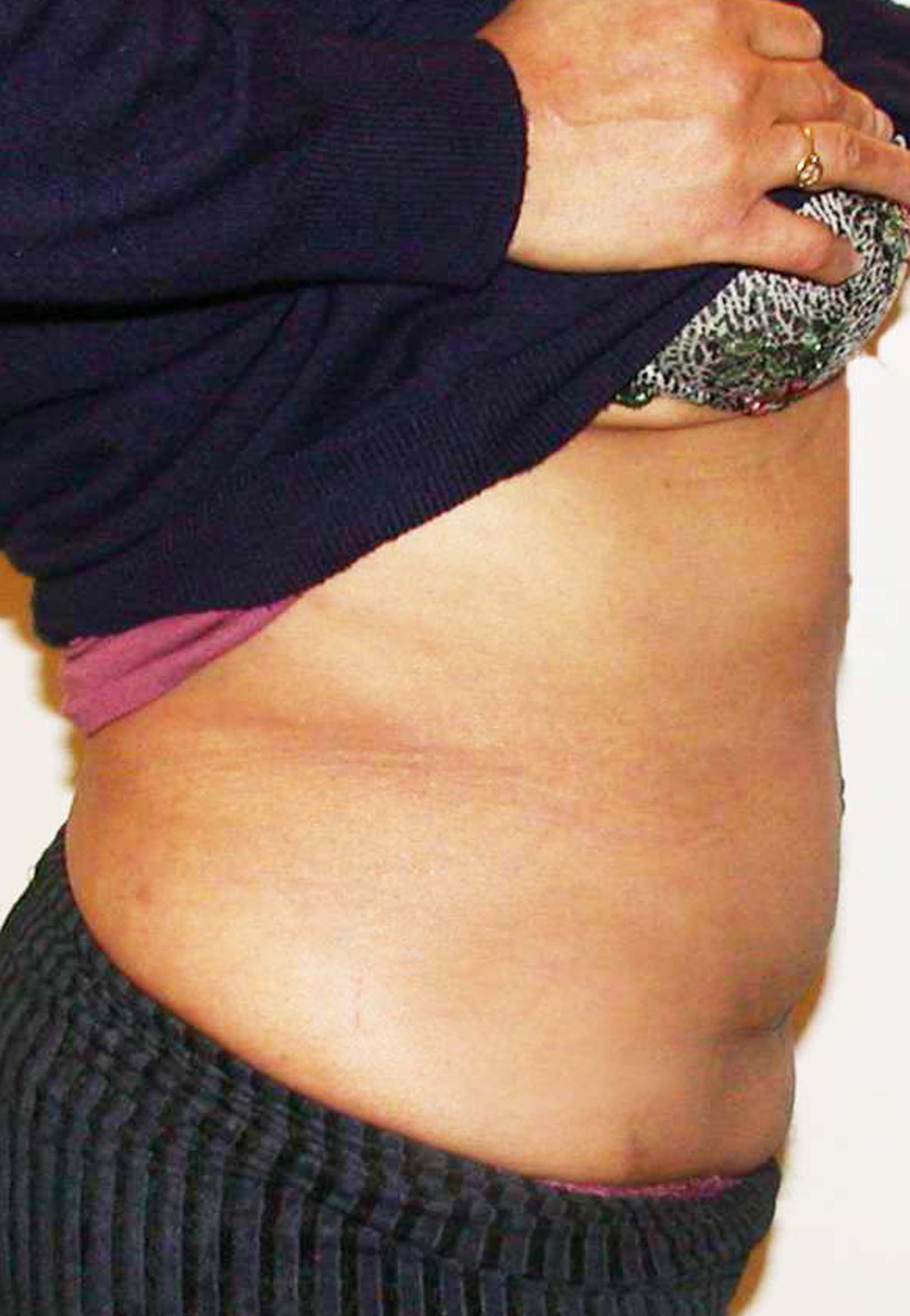 chirurgie-esthetique-pierre-nahon-abdomens09