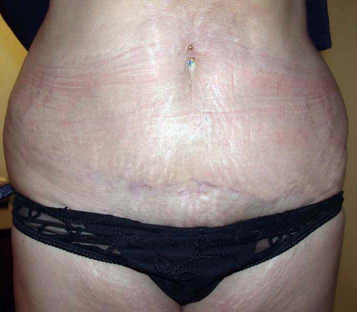 chirurgie-esthetique-pierre-nahon-abdomens11