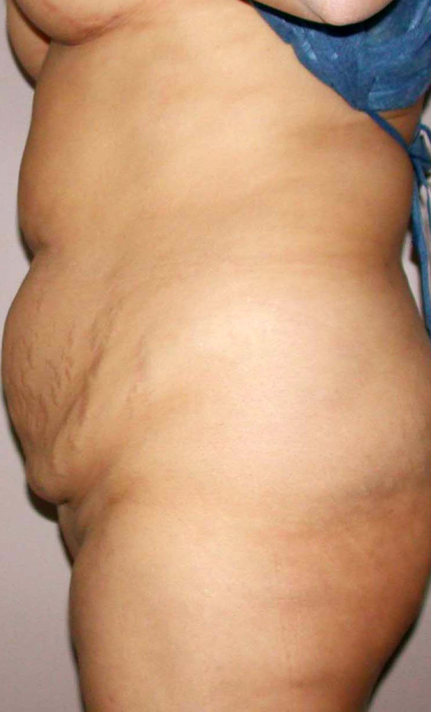 chirurgie-esthetique-pierre-nahon-abdomens12