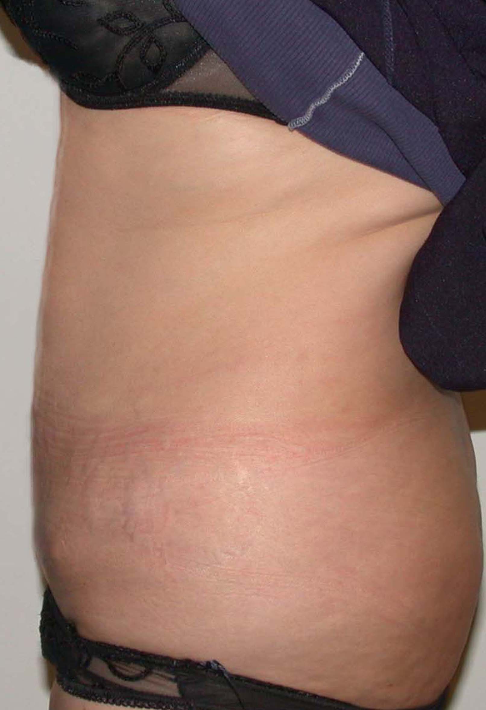 chirurgie-esthetique-pierre-nahon-abdomens13