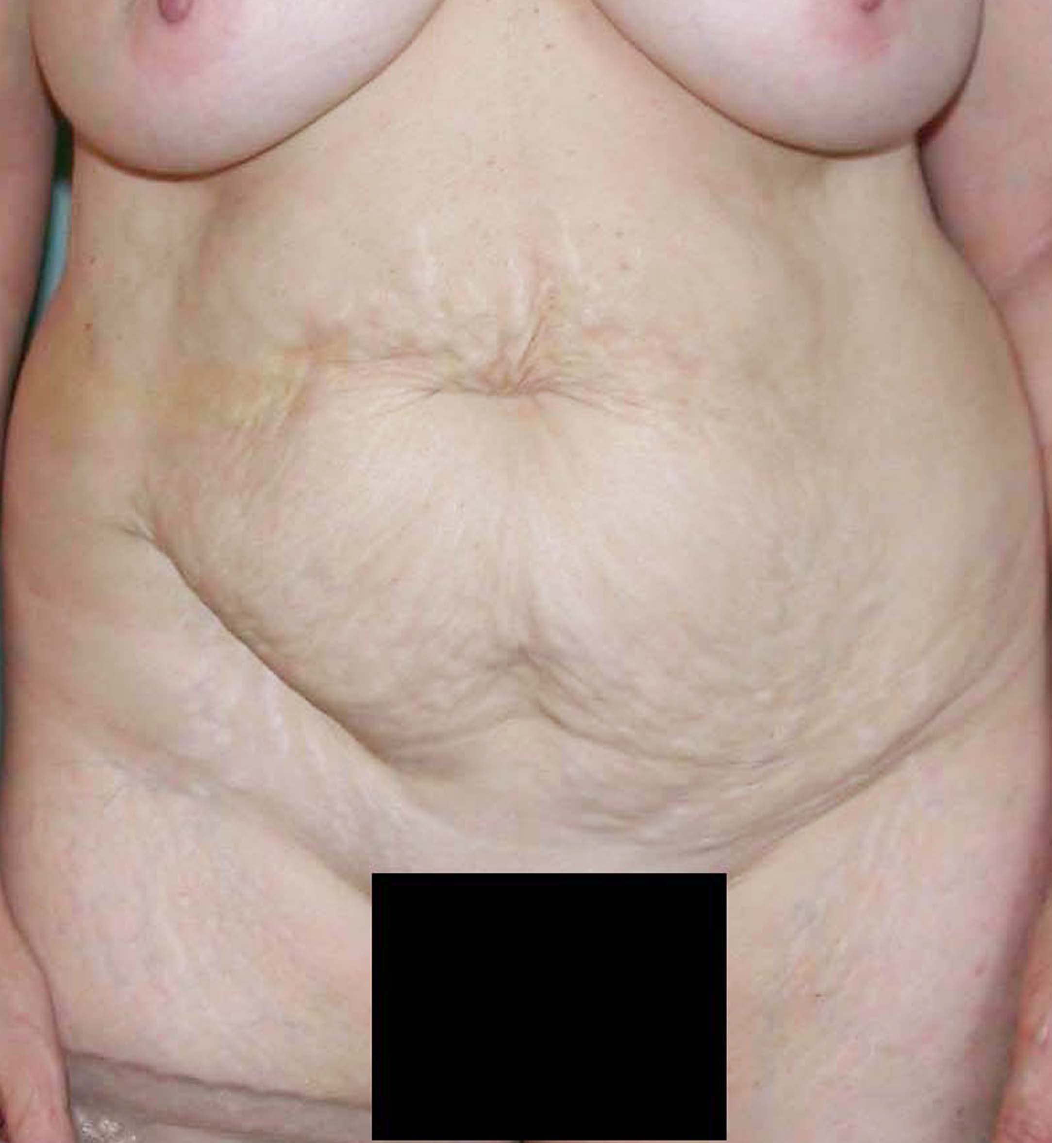 chirurgie-esthetique-pierre-nahon-abdomens14