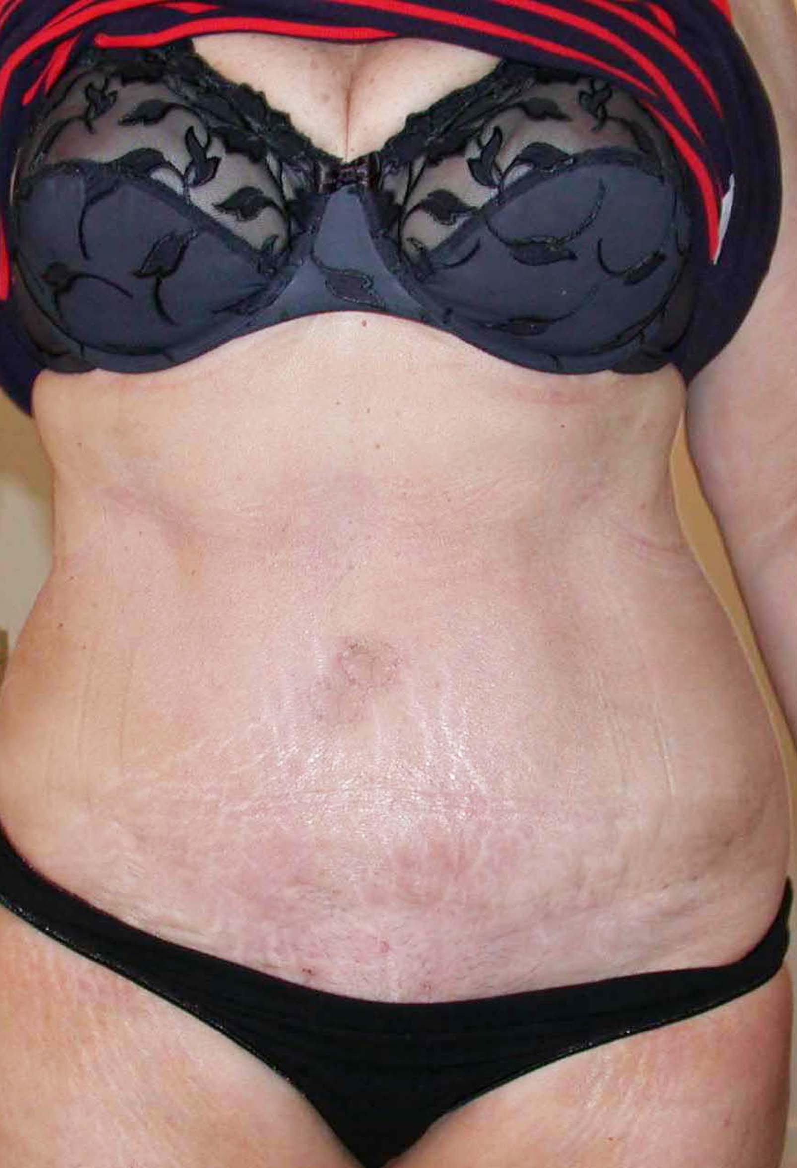 chirurgie-esthetique-pierre-nahon-abdomens15