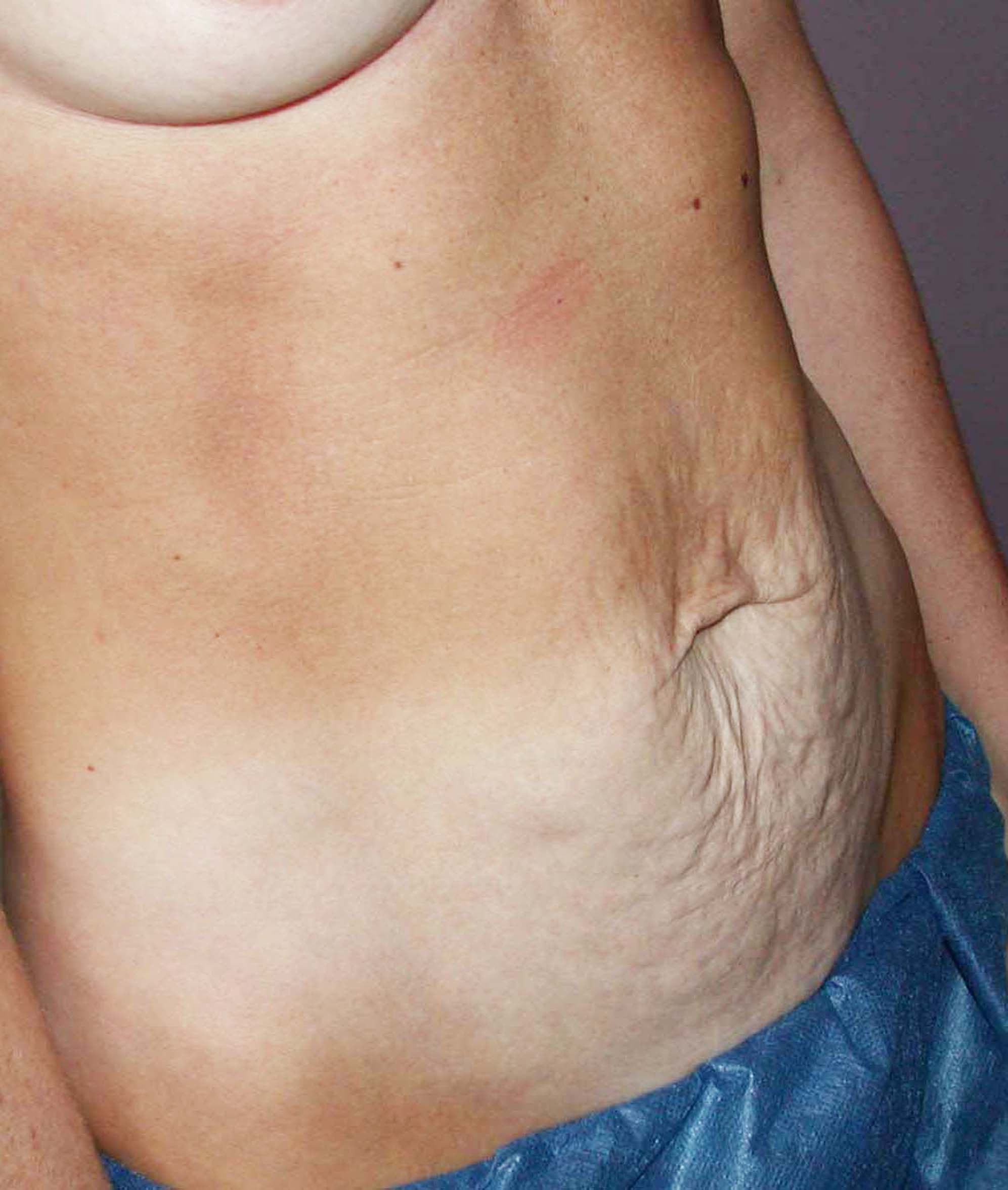 chirurgie-esthetique-pierre-nahon-abdomens16