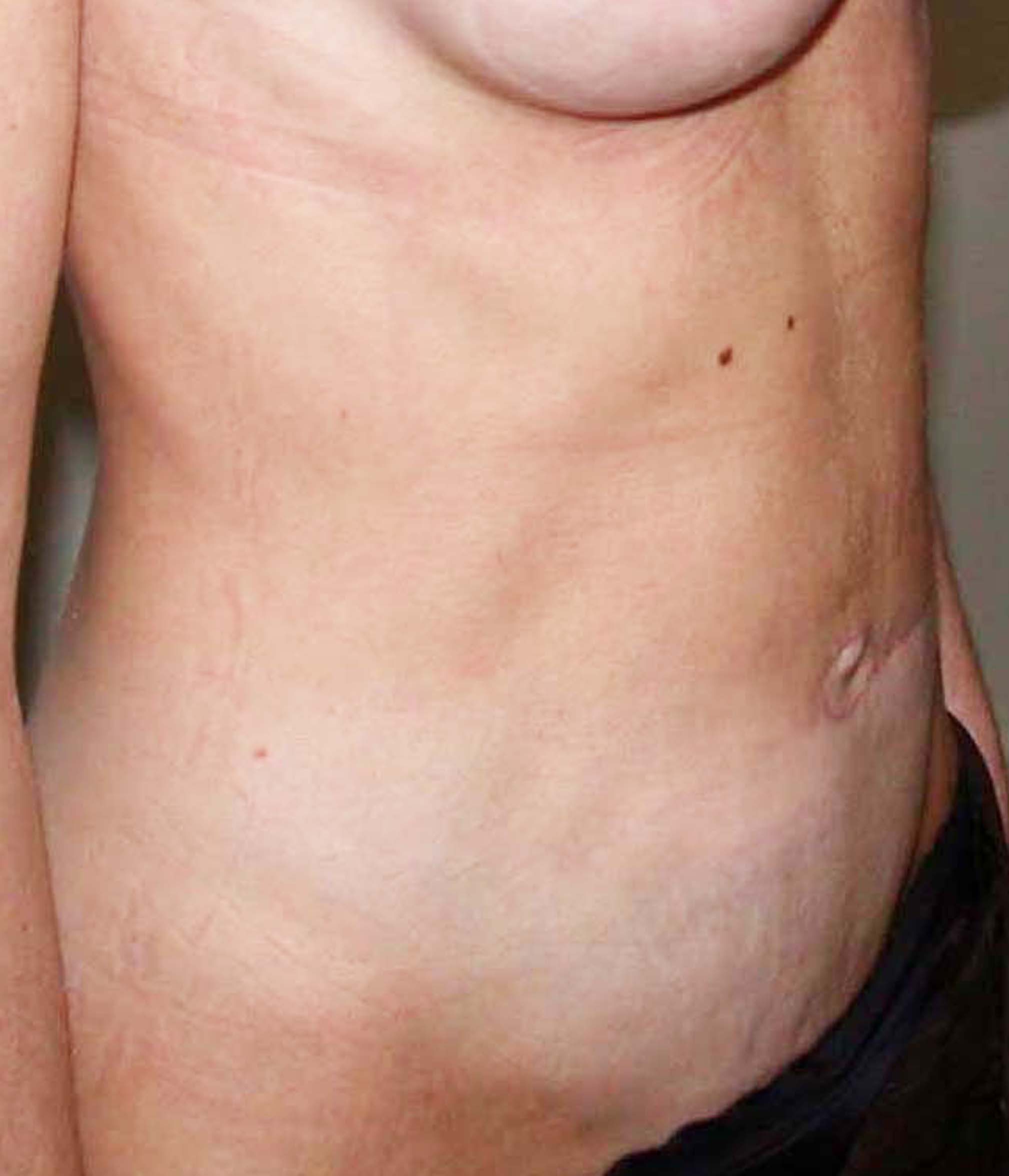 chirurgie-esthetique-pierre-nahon-abdomens17
