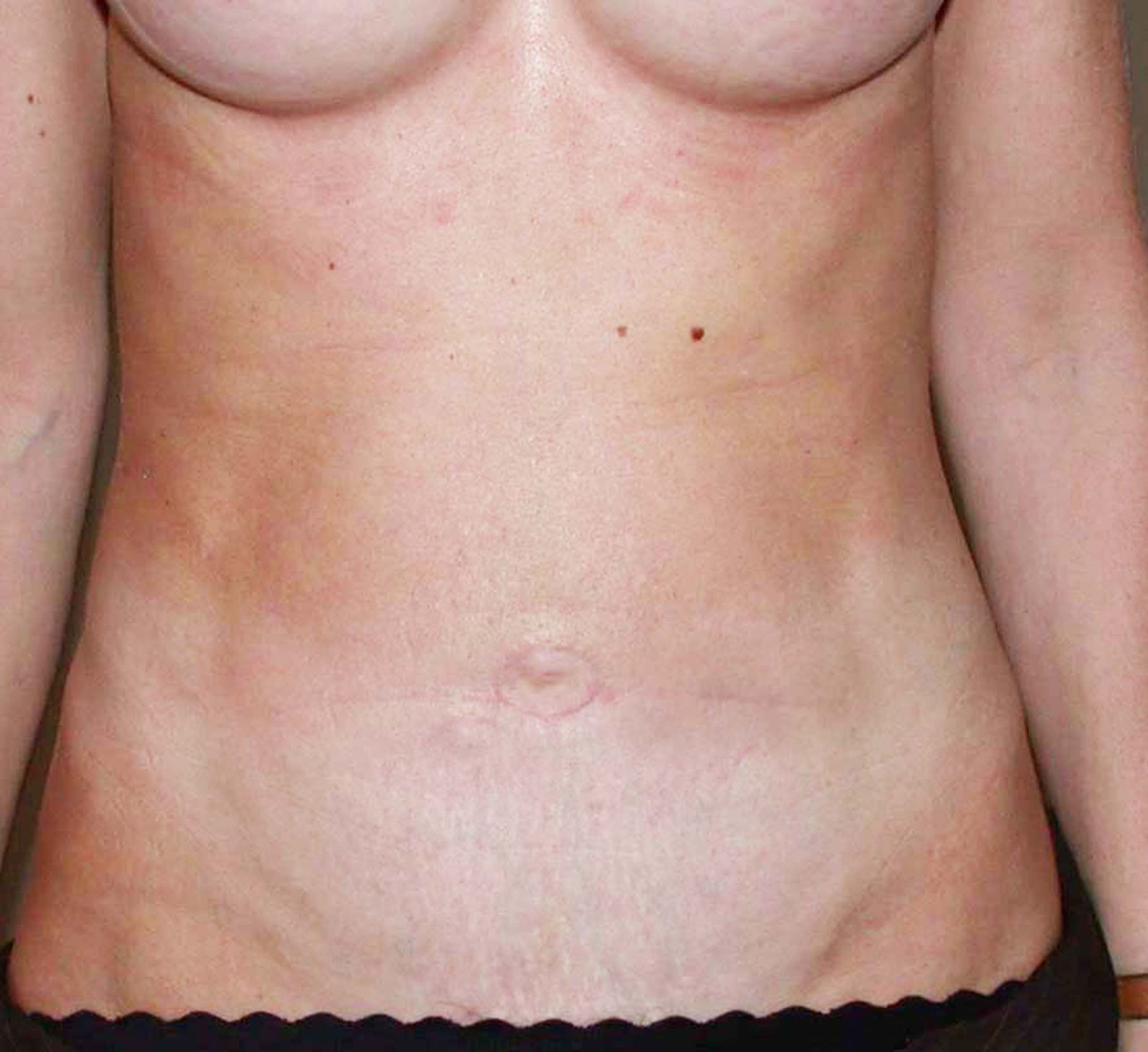 chirurgie-esthetique-pierre-nahon-abdomens18