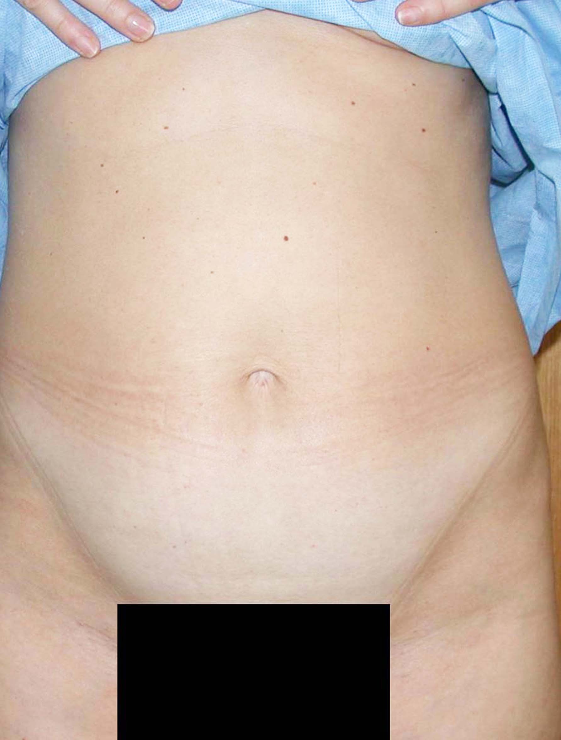 chirurgie-esthetique-pierre-nahon-abdomens19