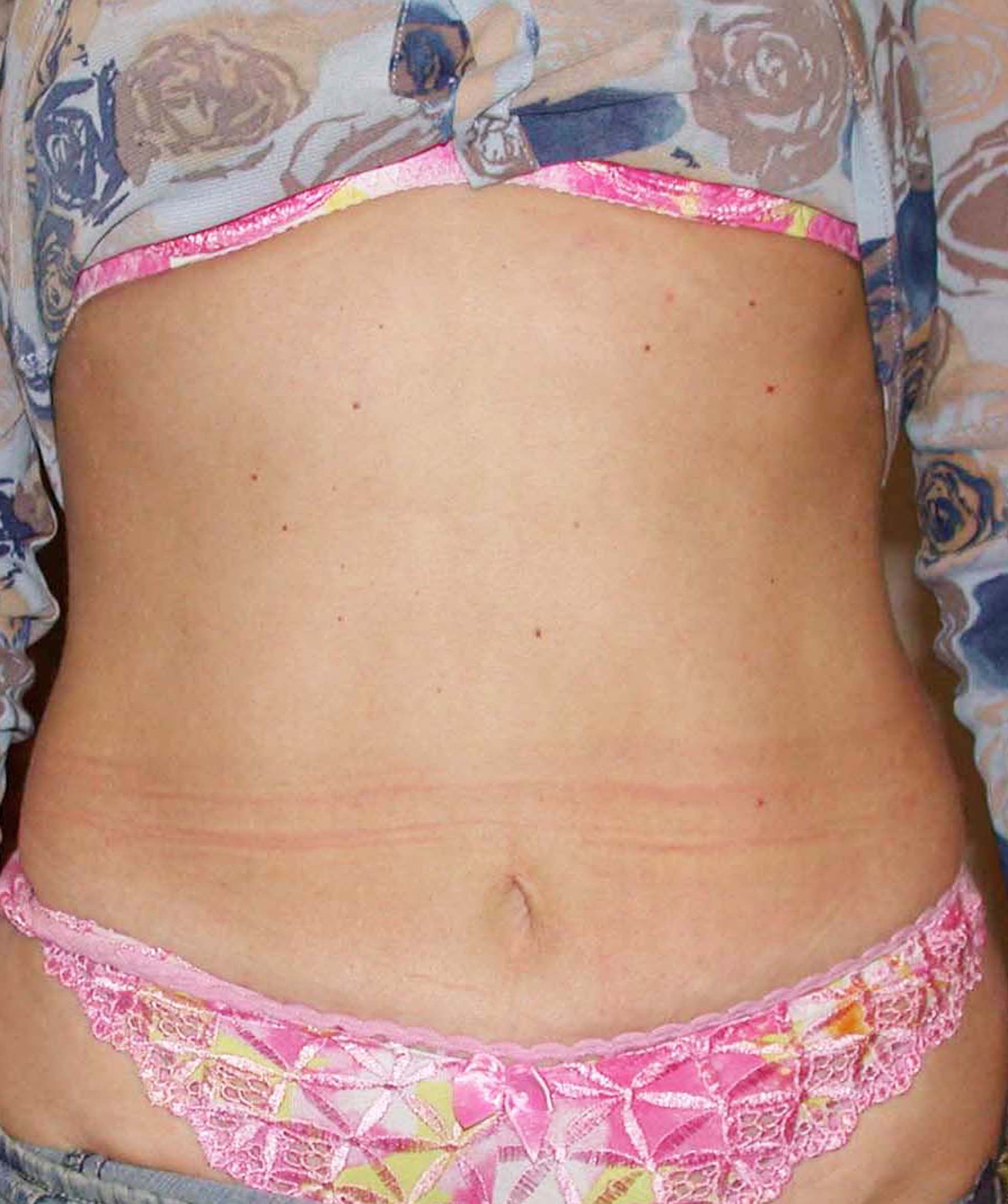 chirurgie-esthetique-pierre-nahon-abdomens20