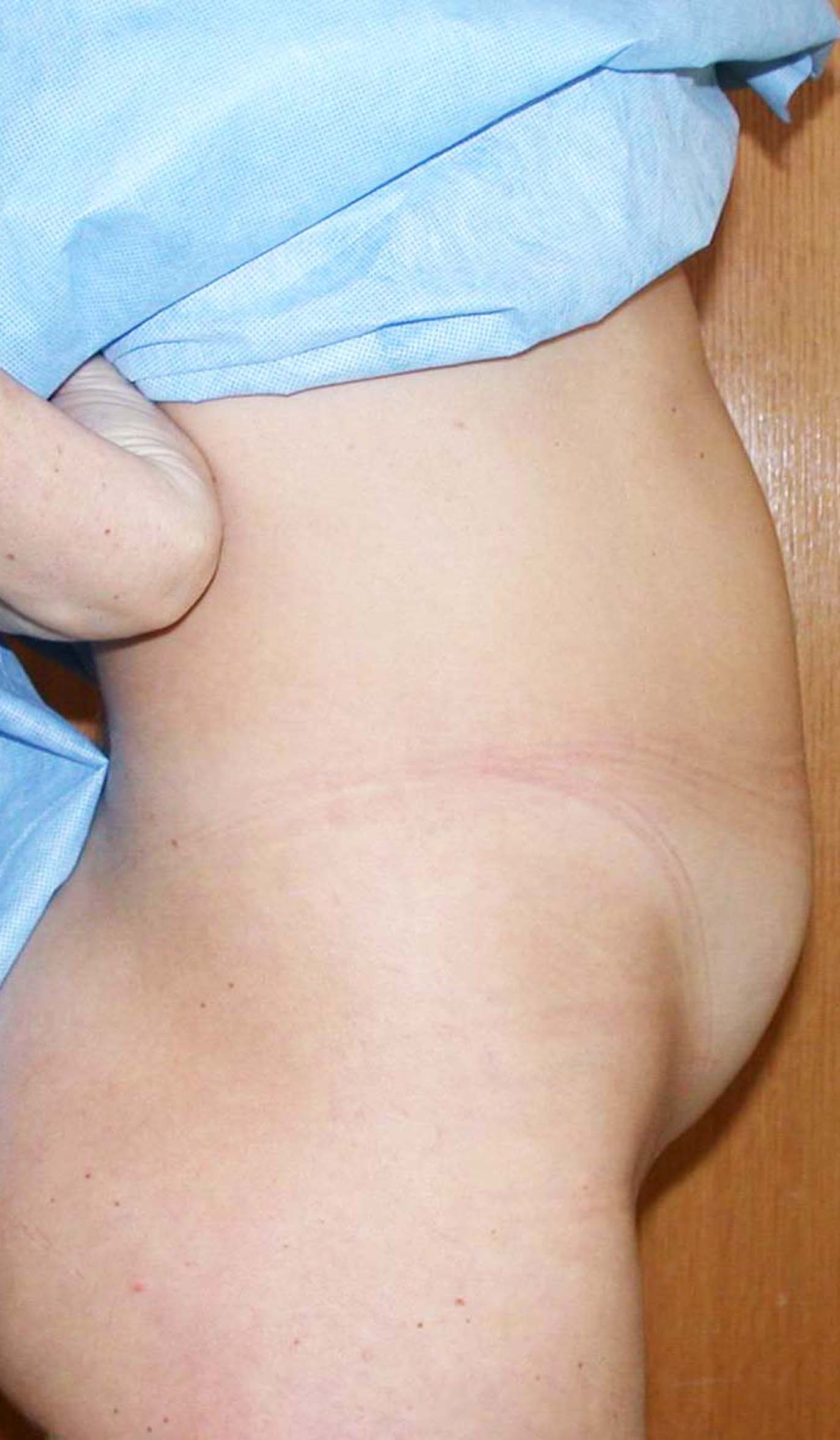 chirurgie-esthetique-pierre-nahon-abdomens21