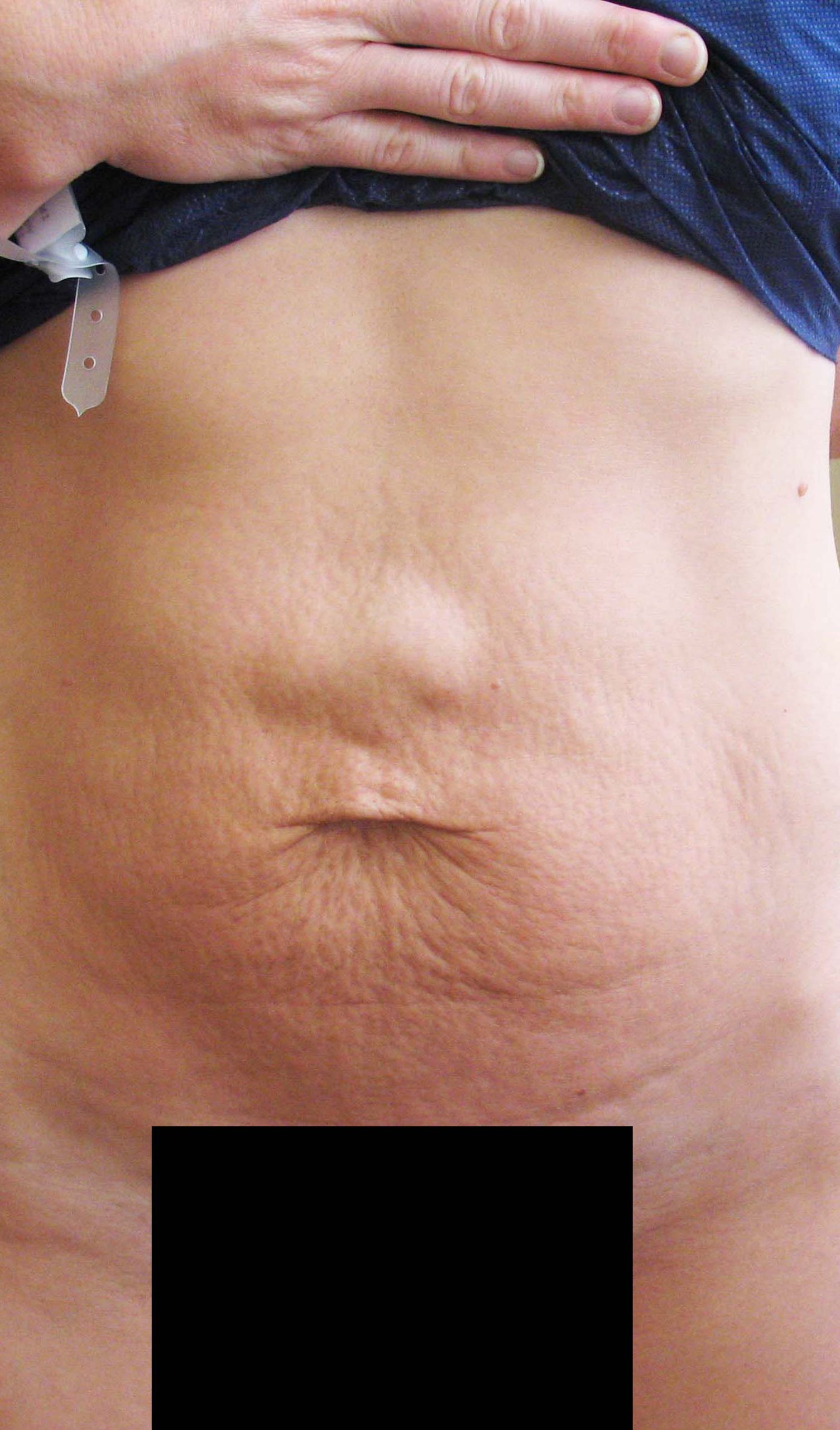 chirurgie-esthetique-pierre-nahon-abdomens23