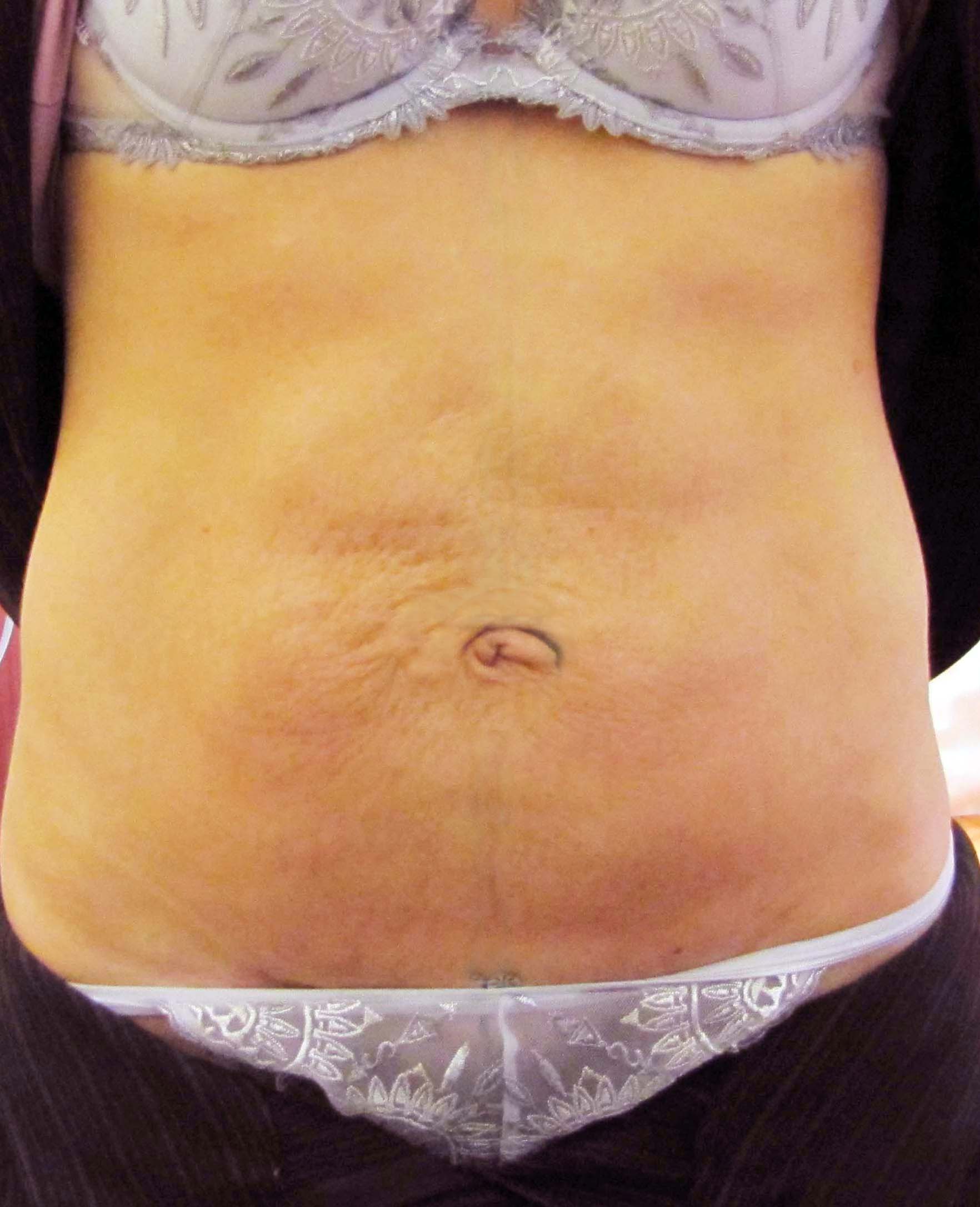 chirurgie-esthetique-pierre-nahon-abdomens24
