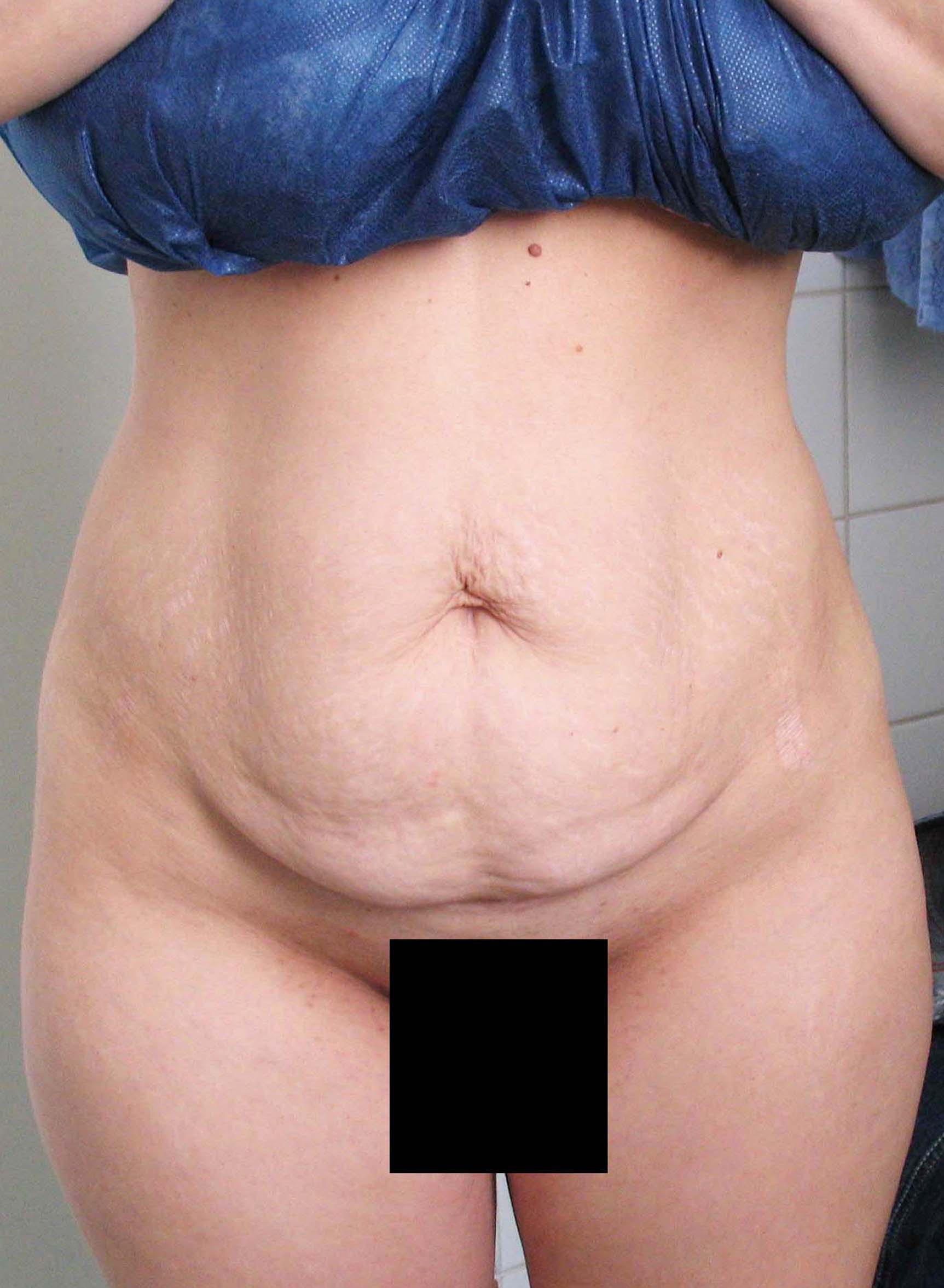 chirurgie-esthetique-pierre-nahon-abdomens25