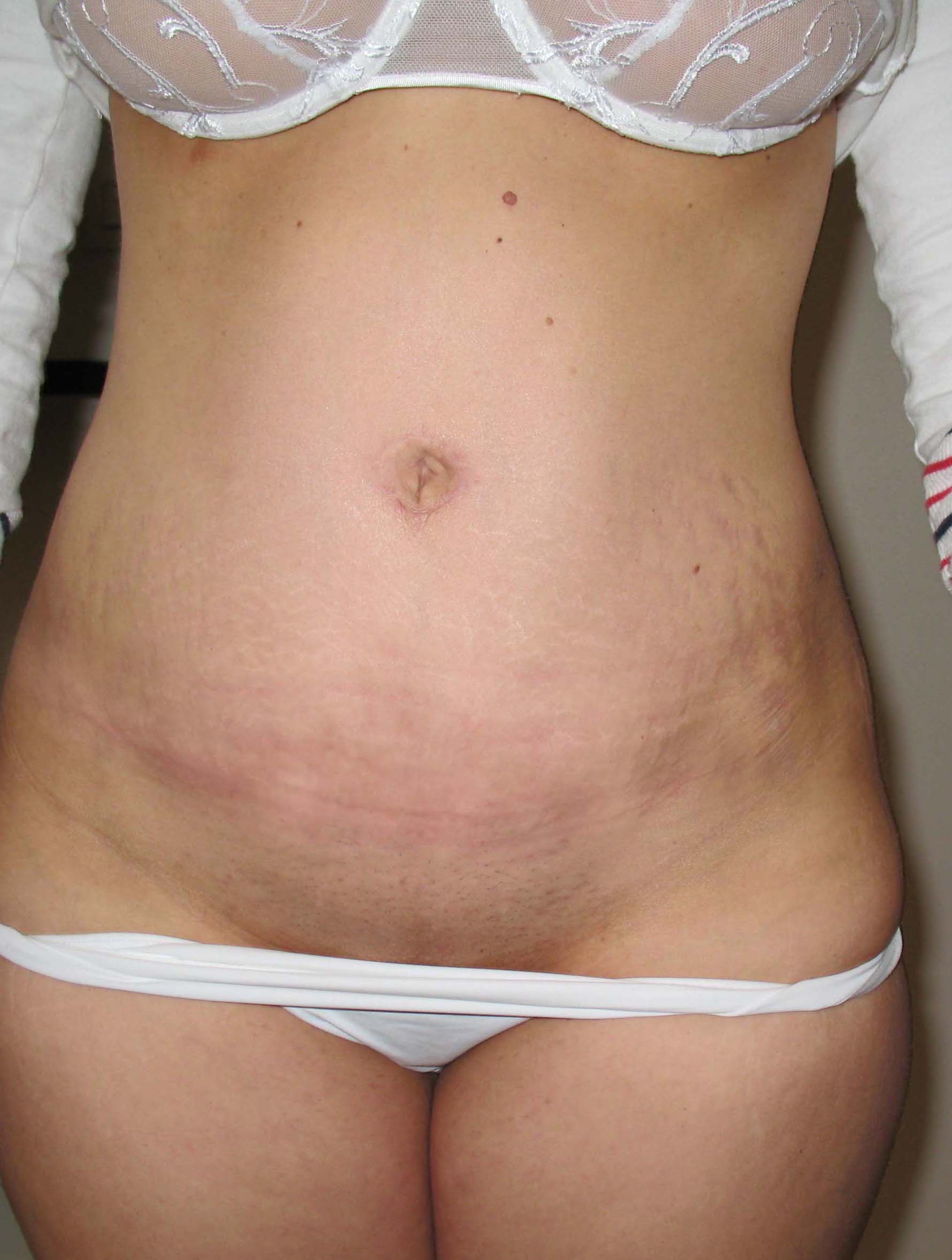 chirurgie-esthetique-pierre-nahon-abdomens26