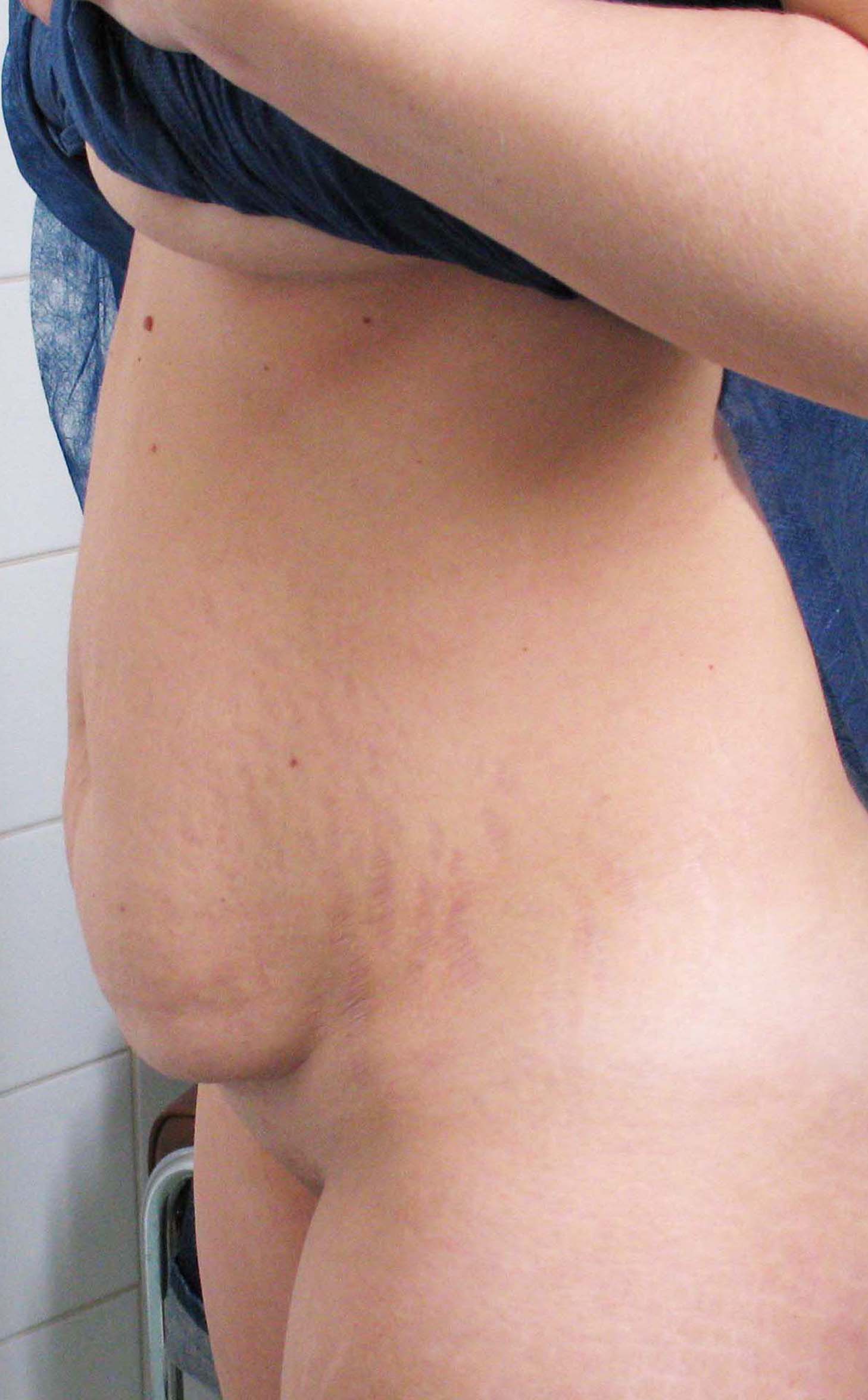 chirurgie-esthetique-pierre-nahon-abdomens27