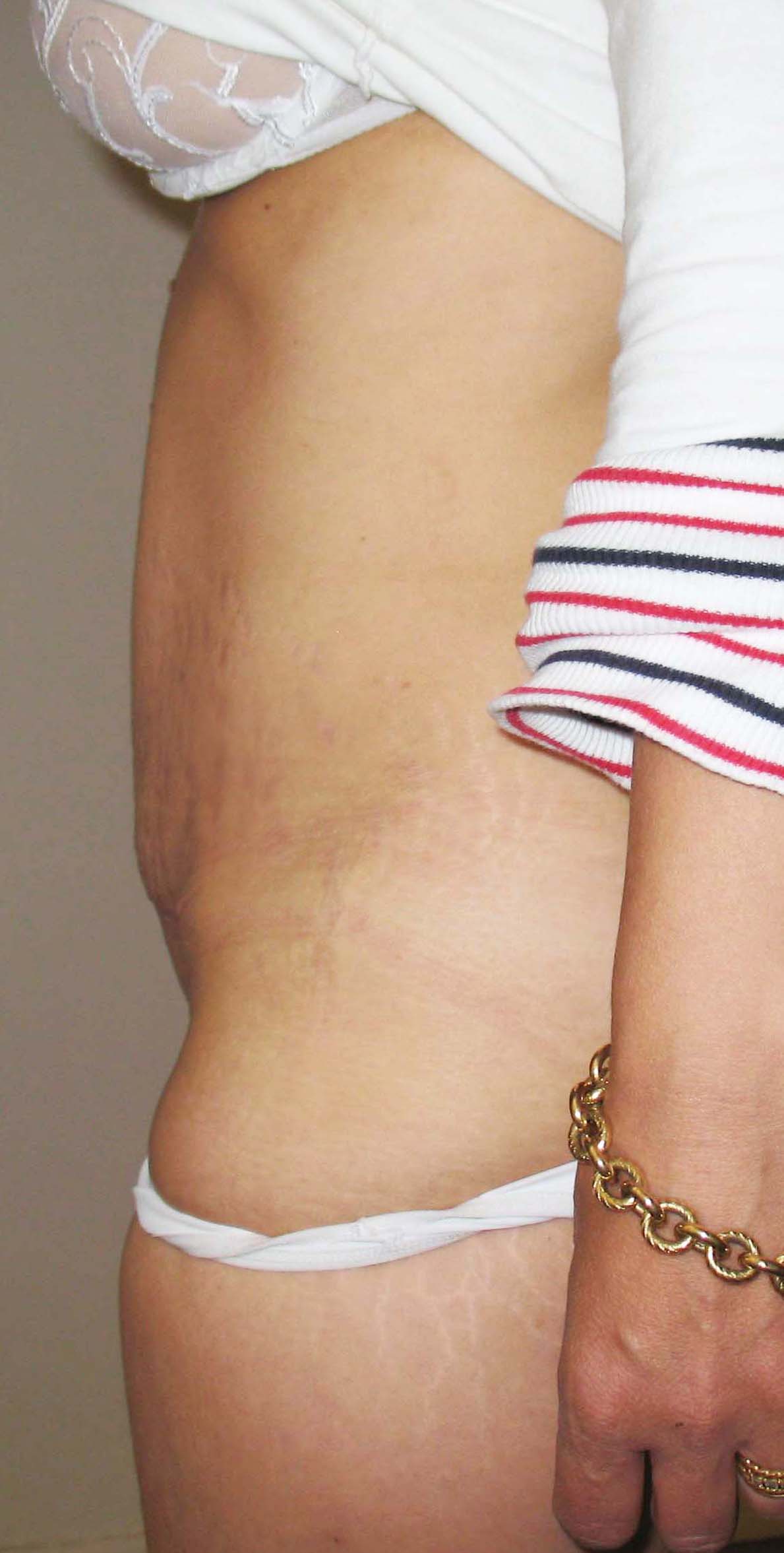 chirurgie-esthetique-pierre-nahon-abdomens28