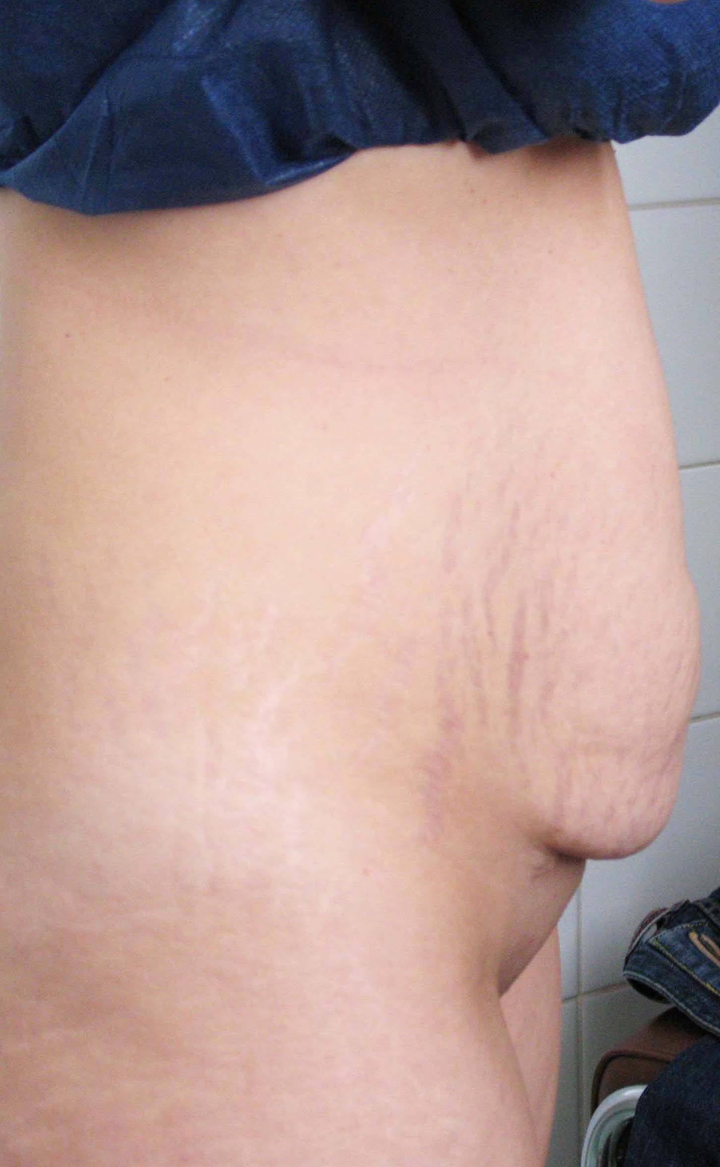 chirurgie-esthetique-pierre-nahon-abdomens29