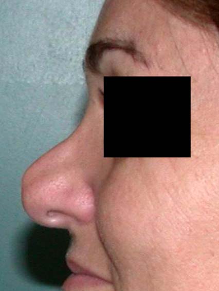 chirurgie-esthetique-secondaire-pnahon032